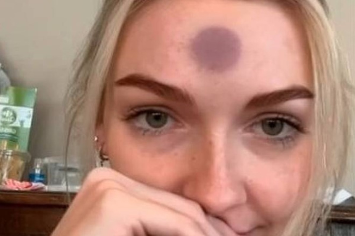 Influencer fica com hematoma após grudar “plug que suga ânus” na testa