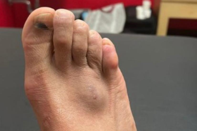 Neymar Mostra Foto Do P Lesionado E O Quadro Parece Bem Grave