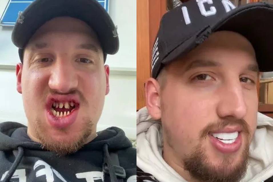 Homem Coloca Lente De Contato Nos Dentes E Fica Sorriso Assustador