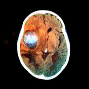 Existem dois tipos de aneurisma: o roto, que é o aneurisma que ainda não se rompeu, e o não roto, que está rompido e caracteriza uma emergência médica séria Existem dois tipos de aneurisma: o roto, que é o aneurisma que ainda não se rompeu, e o não roto, que está rompido e caracteriza uma emergência médica séria