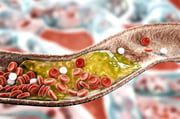 Dentre as doenças cardiovasculares que mais fazem vítimas fatais, o Acidente Vascular Cerebral (AVC) se destaca. Ele é causado devido à presença de placas de gordura que entopem os vasos sanguíneos cerebrais. Entre os sintomas estão: dificuldade para falar, tontura, dificuldade para engolir, fraqueza de um lado do corpo, entre outros