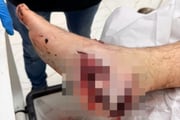 Pé atingido por tiro do suspeito Roberto Marques Trovão Lafaeff, que teria participado de ataque a carro-forte em SP