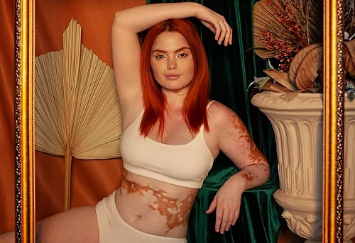 Com tipo raro de vitiligo, influencer é símbolo de representatividade