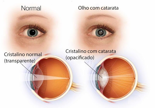 Olhos catarata