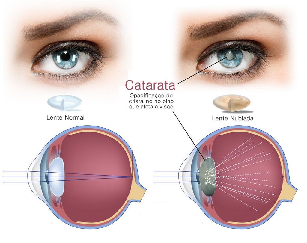 Cirurgia De Catarata Resgata Qualidade De Vida Ao Reverter Cegueira 