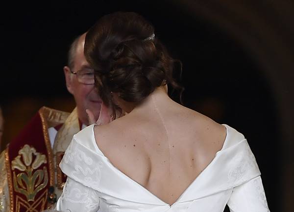 Cicatriz de escoliose da princesa Eugenie