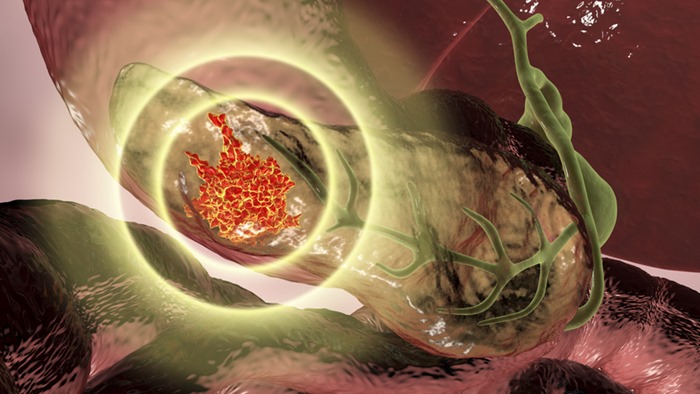Ilustração mostra câncer no pâncreas - Metrópoles