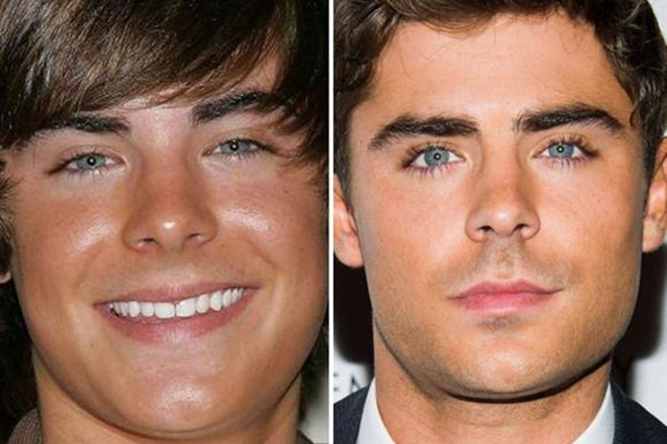 Montagem colorida de Zac Efron antes e depois de passar por procedimentos estéticos - Metrópoles 