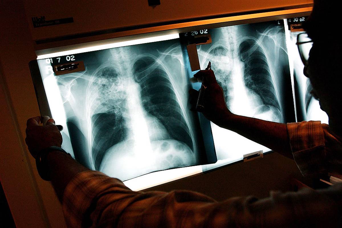 Novo teste portátil para detectar tuberculose tem 100% de precisão