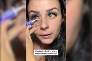 Foto colorida de joivem com conjuntivite passando remédio no olhos com conjuntivite