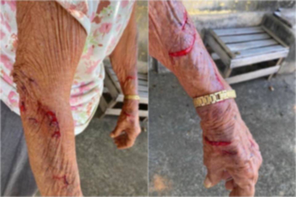 Foto colorida de braços machucados de mãe idosa de homem suspeito de espanca-la- Metrópoles