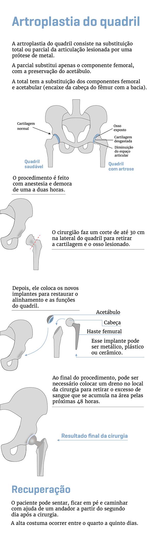 Infografia vertical mostra o passo a passo de uma cirurgia de quadril - Metrópoles