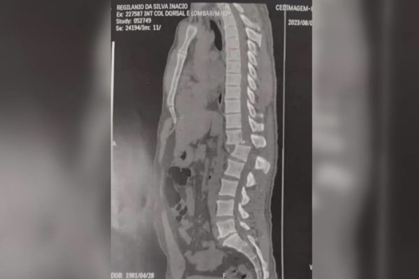 Imagem mostra raio-x da coluna de homem que se feriu em acidente registrado em academia do Ceará - Metrópoles