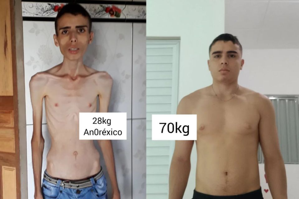 Foto colorida de um jovem sem camisa extremamente magro e com o corpo saudável - Metrópoles