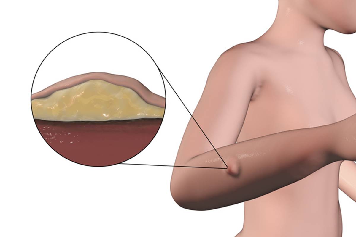 Ilustração de braço de pessoa com lipedema - Metrópoles