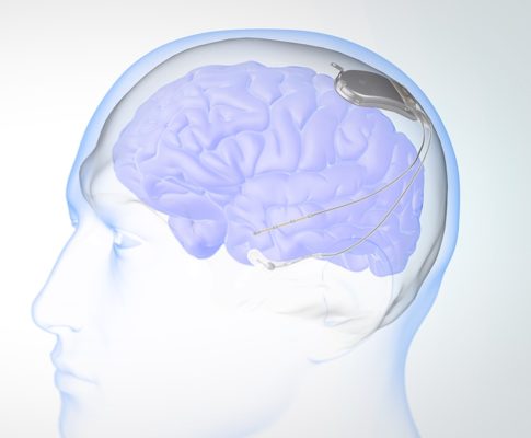 Ilustração mostra como o neurochip atua no cérebro para impedir as crises de TOC ou de epilepsia