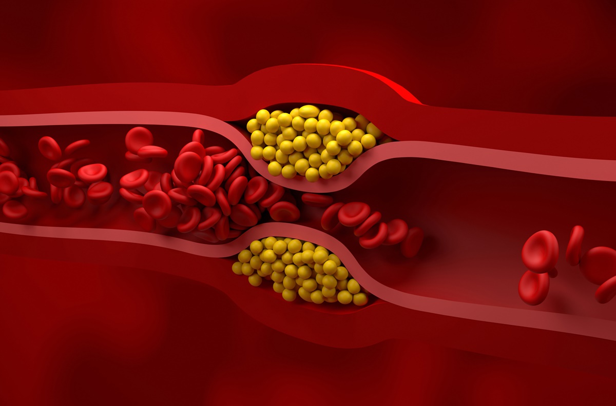 Ilustração de artéria com gordura - Metrópoles