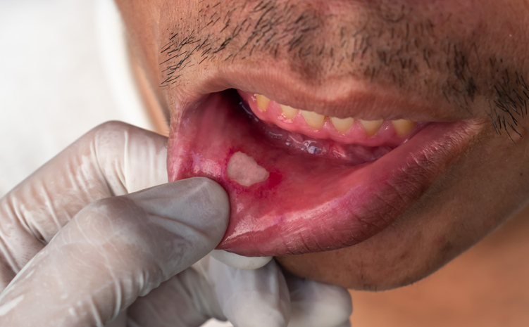 Úlcera aftosa, afta ou úlcera de estresse na boca de paciente asiático do sexo masculino.