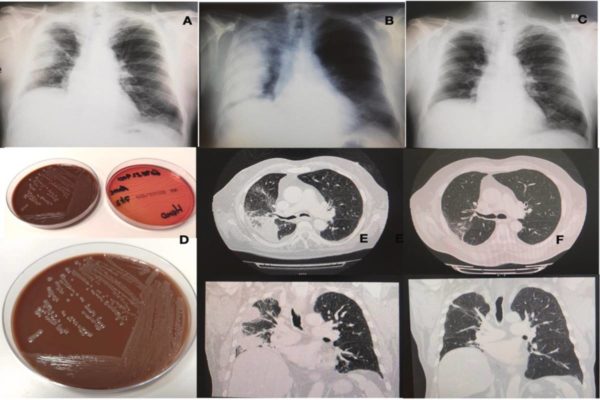 Imagem colorida de radiografia e exames de homem com bactéria - Metrópoles