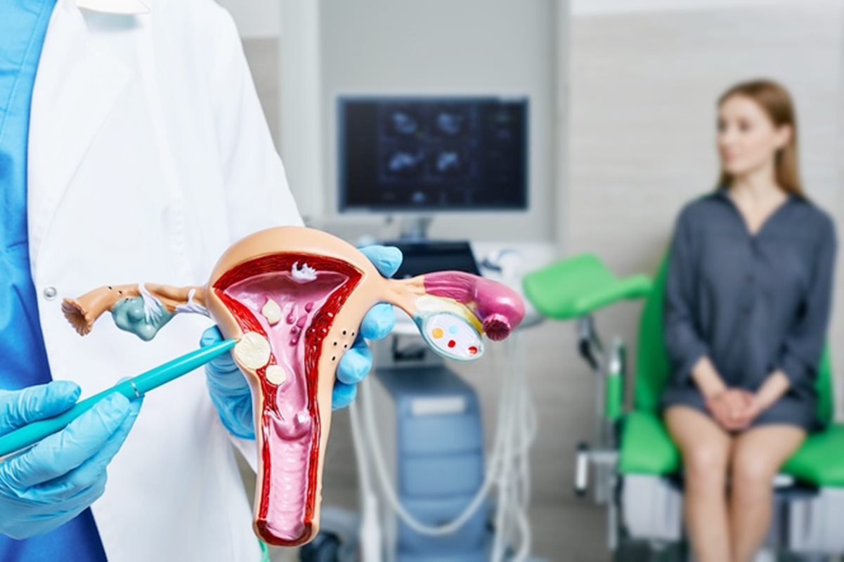 Miomas uterinos: tudo o que você precisa saber sobre eles