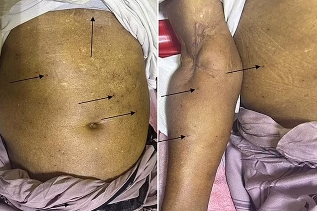 Imagem mostra barriga de homem com marcas de picada de abelha - Metrópoles