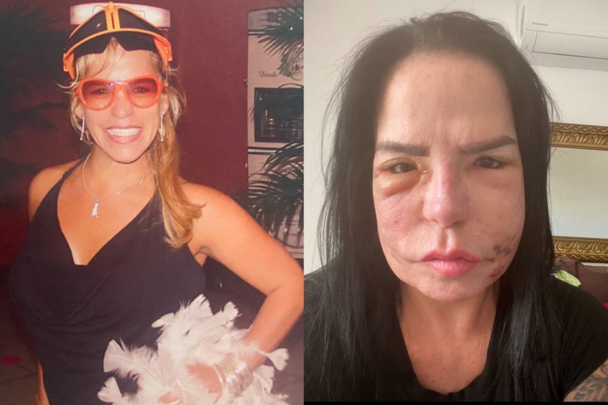 Foto mostra o antes e depois de Jaqueline Chaves, mulher que foi vítima do PMMA