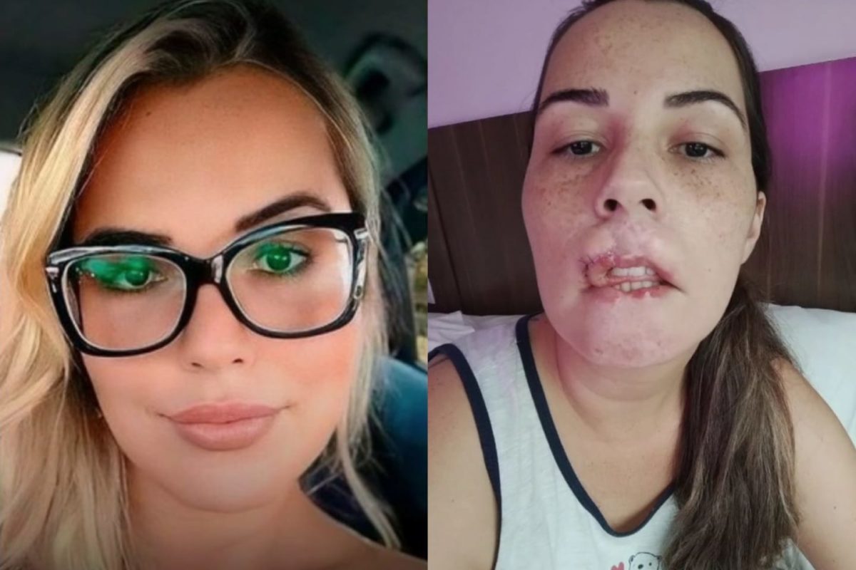 Foto mostra o antes e depois de Mariana Michelini, mulher que foi vítima do PMMA