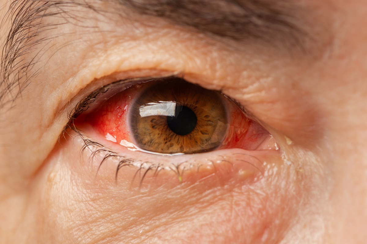 Foto Close-up de um olho de sangue vermelho irritado 