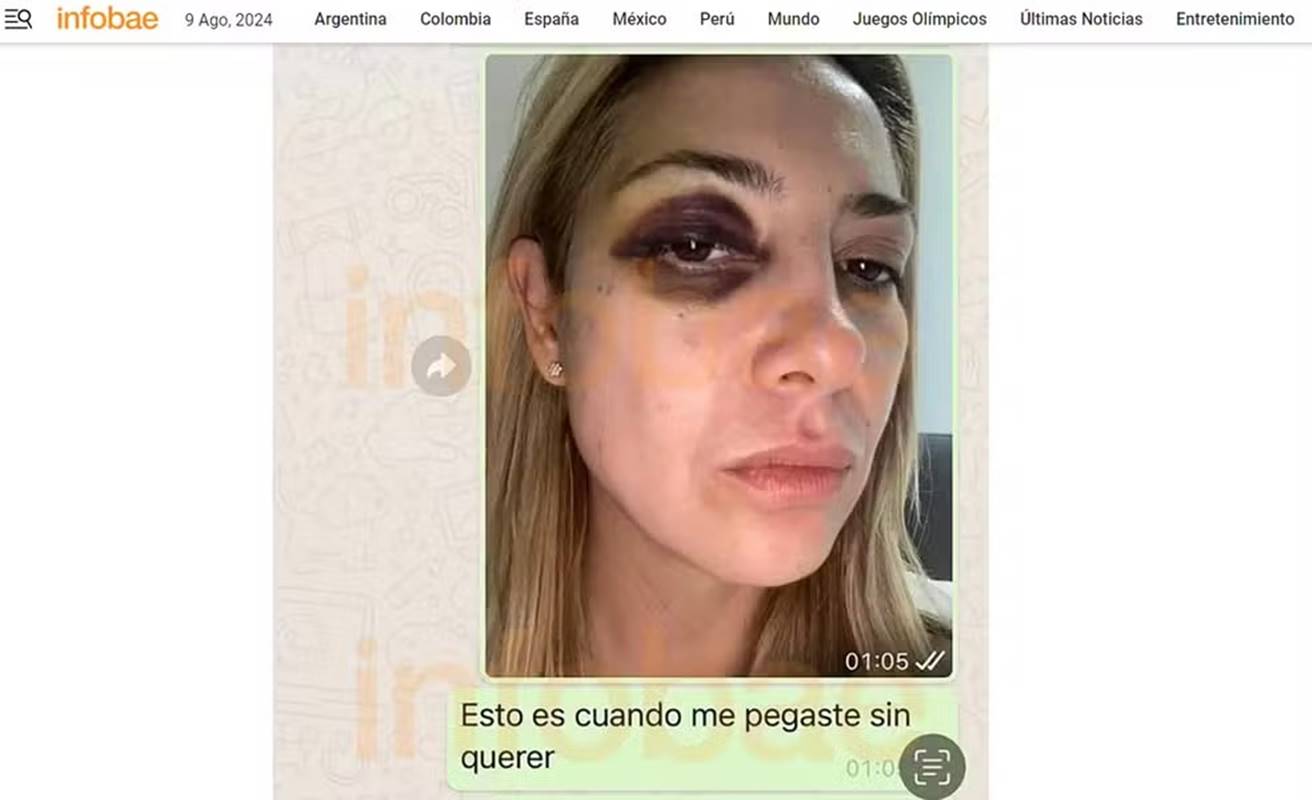 imagem colorida fabiola yanez mostra hematomas