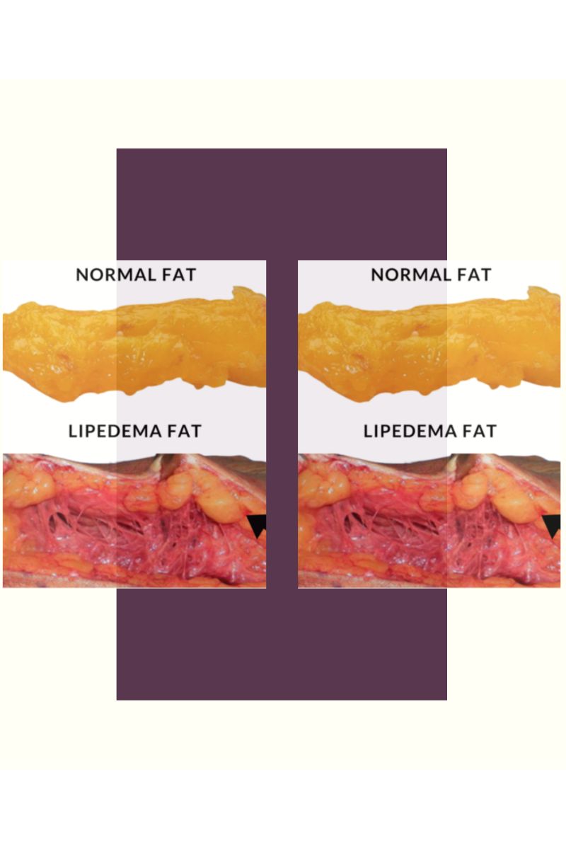 Comparação entre gordura normal e gordura com lipedema - Metrópoles