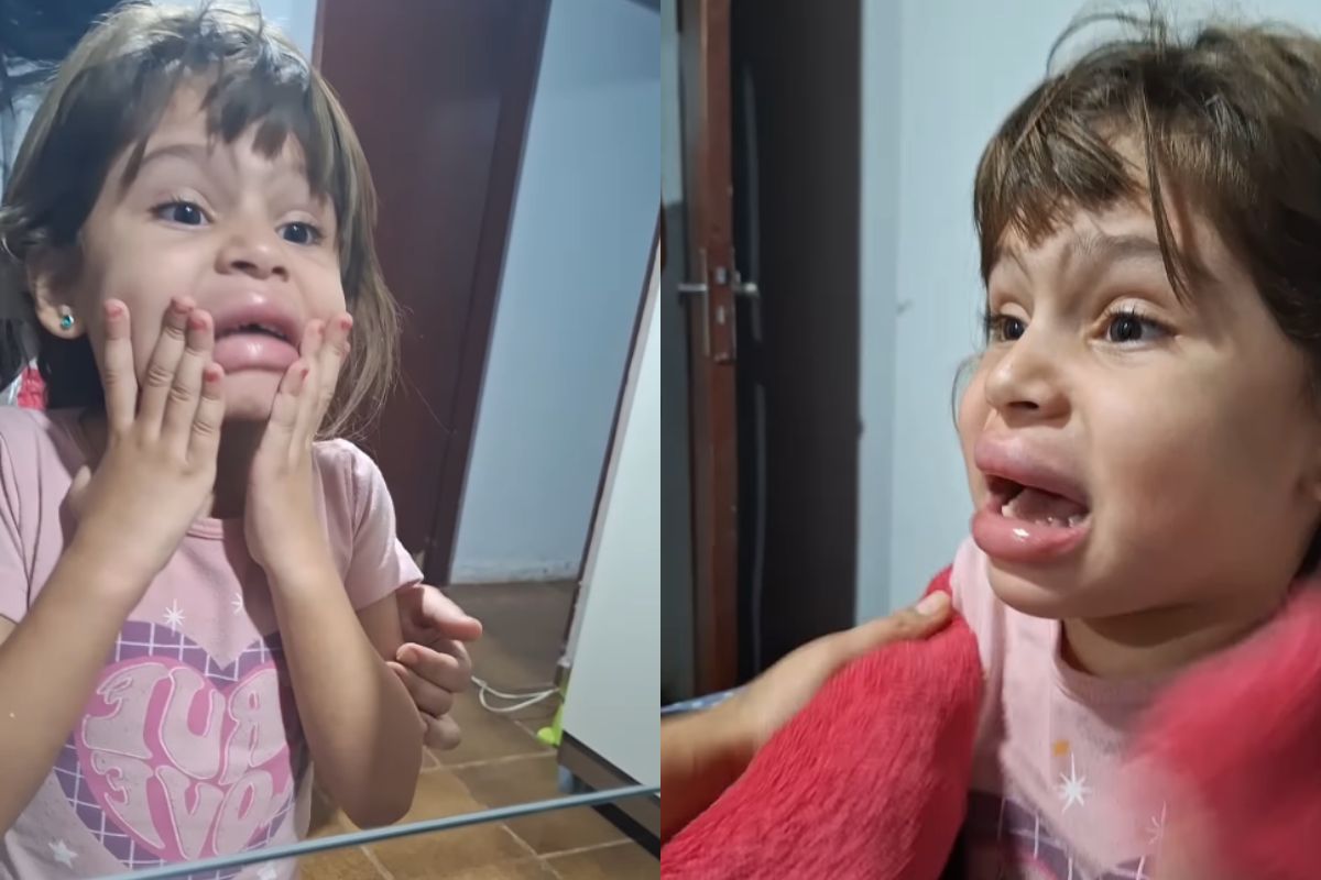 Foto colorida de uma menina com a boca inchada - Metrópoles