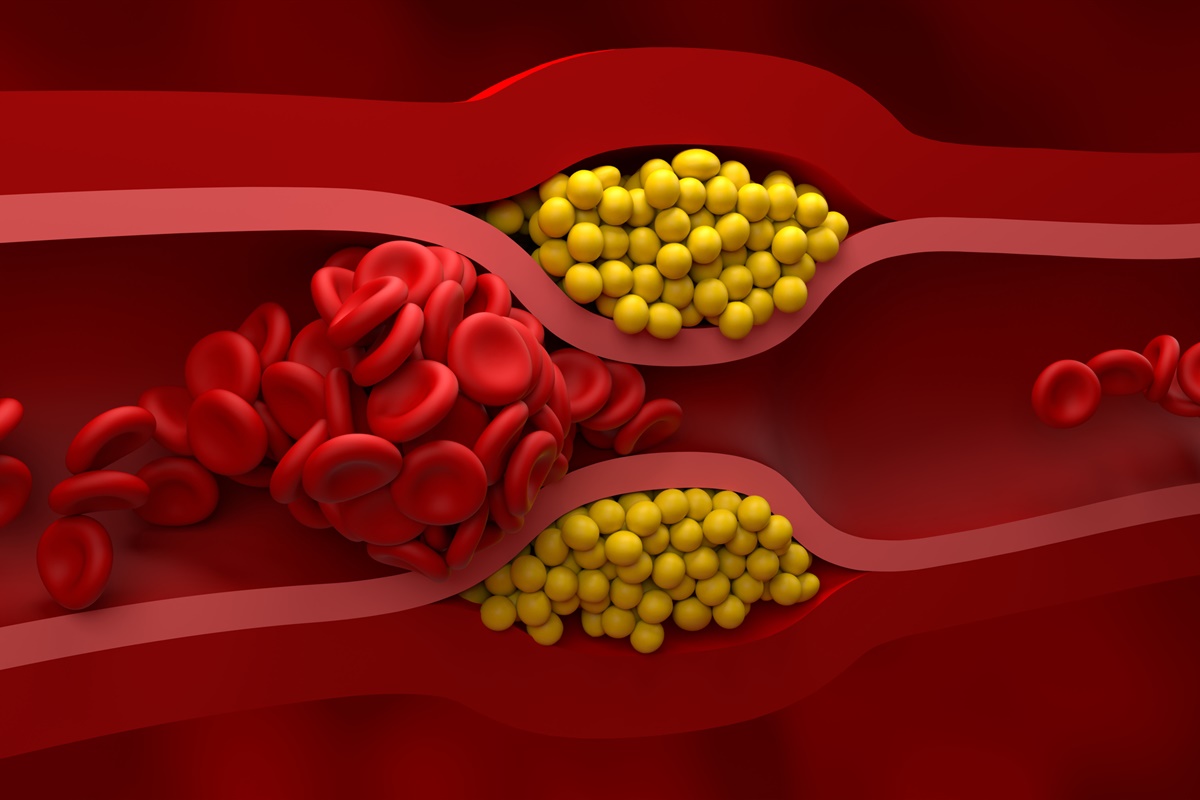 Ilustração colorida de artéria bloqueada por gordura. O sangue não consegue passar - Metrópoles 