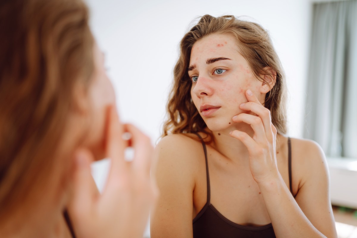 Cicatrizes de acne: veja como prevenir e dicas para cuidar