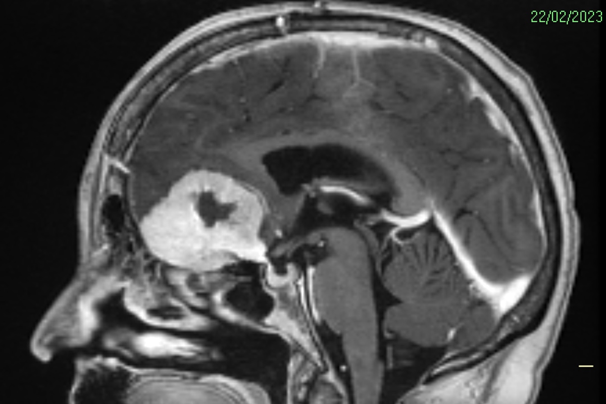 Imagem de cérebro de paciente com tumor - Metrópoles