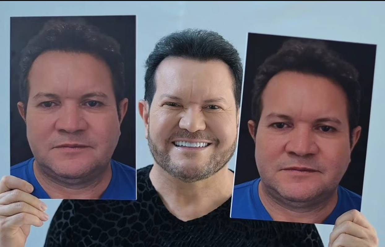 Foto colorida de Ximbinha após harmonização facial - Metrópoles