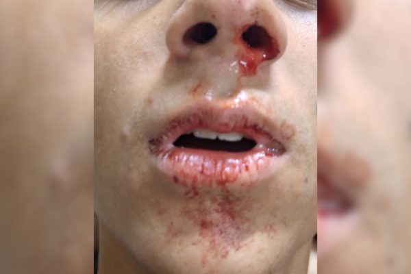 Foto colorida de menino de 14 anos agredido pelo PRF com nariz e boca sangrando - Metrópoles