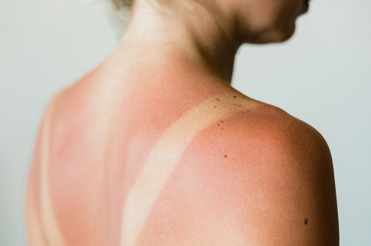 Foto colorida de mulher com queimadura do sol - Metrópoles