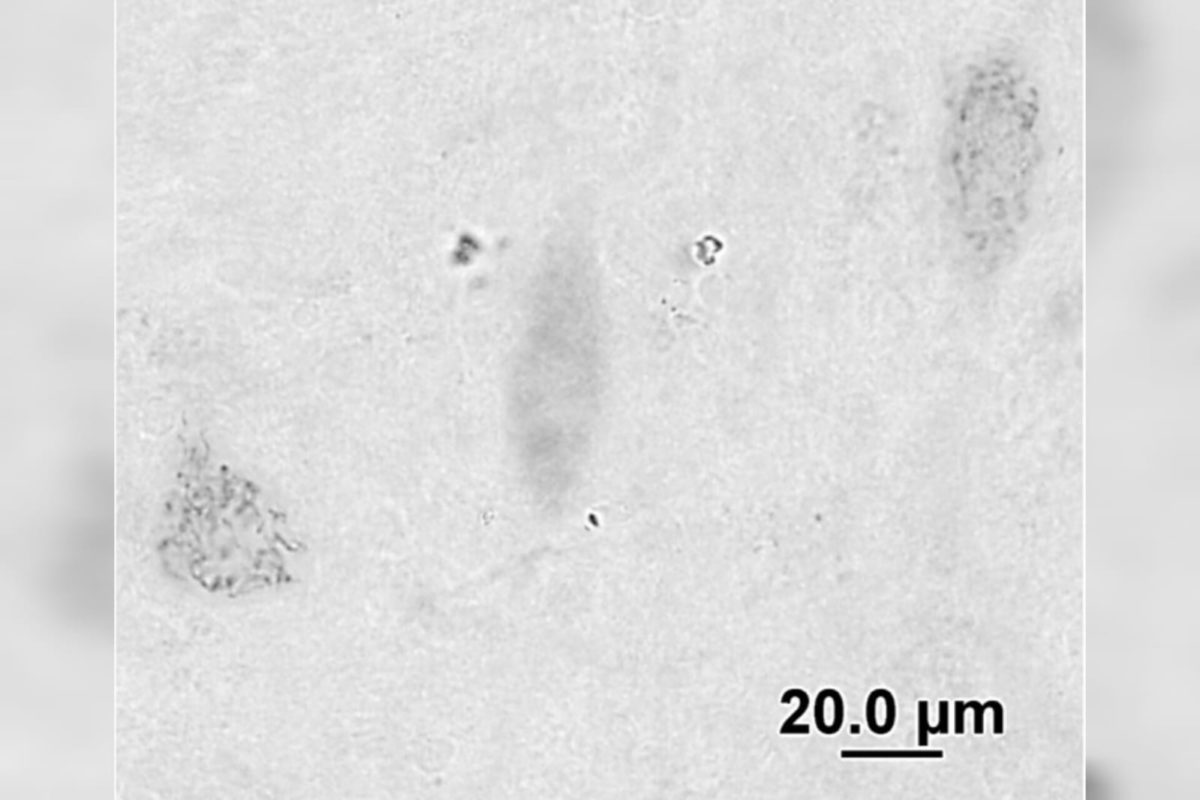 Alzheimer-neuronios-com-granulos-1200x800 Cientistas acreditam ter descoberto a verdadeira causa do Alzheimer