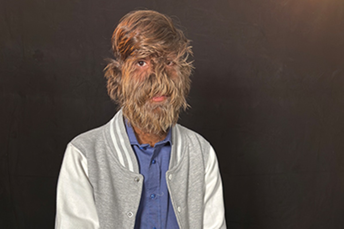 Vídeo. Indiano é considerado homem mais peludo do mundo pelo Guinness