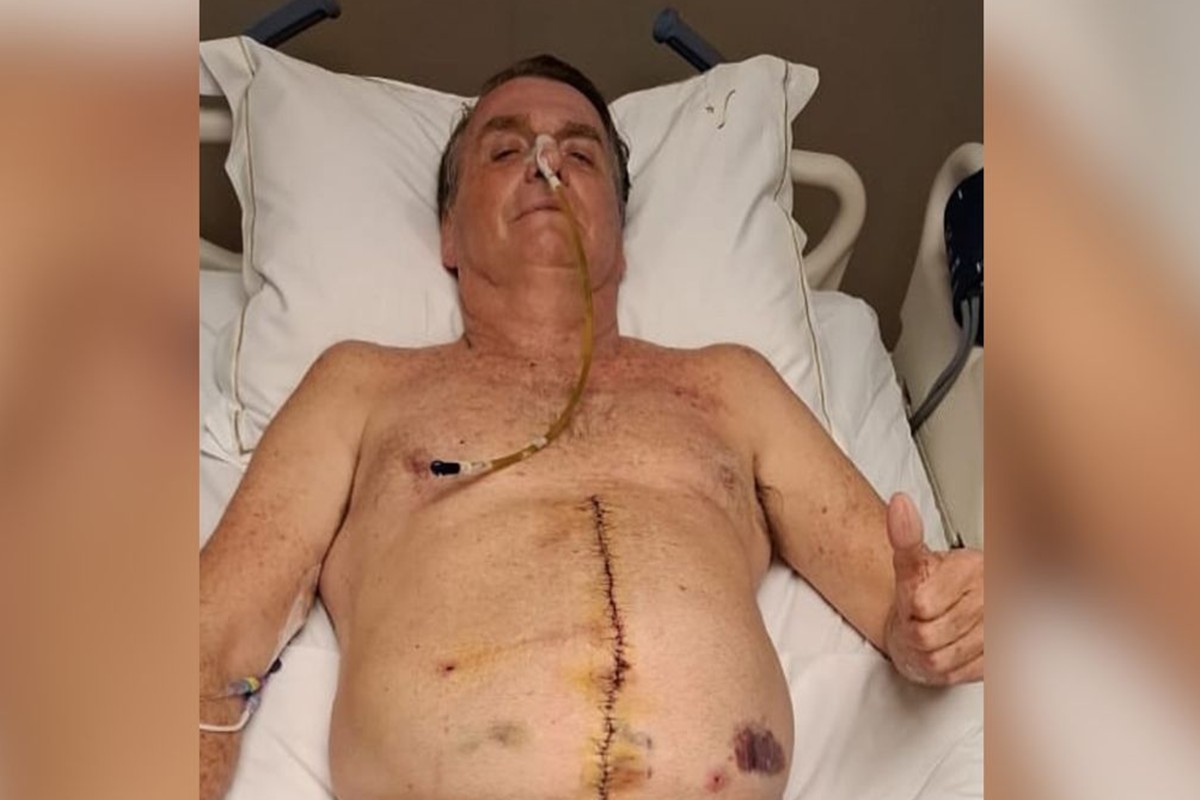 Imagens fortes! Bolsonaro posta barriga aberta com intestino à mostra