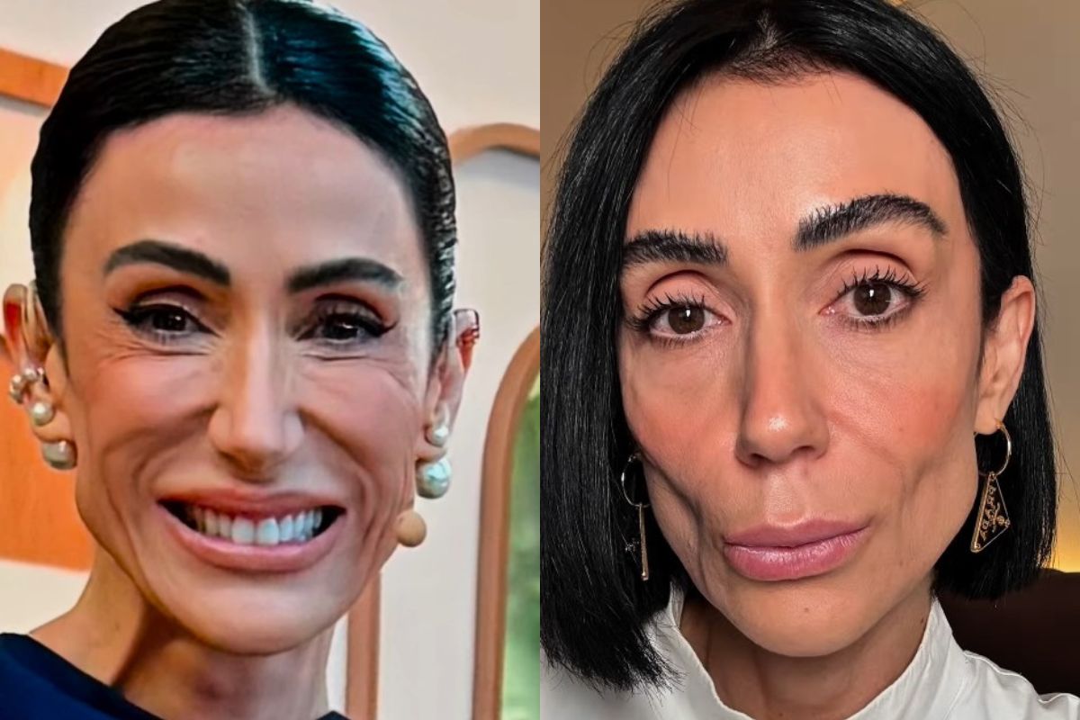 Apresentadora de TV retira preenchimento e alerta sobre excessos
