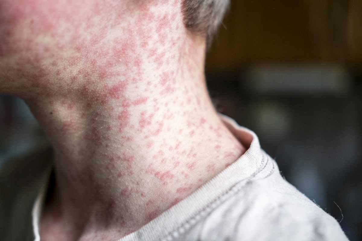 7 respostas para se proteger contra o sarampo, que volta a preocupar