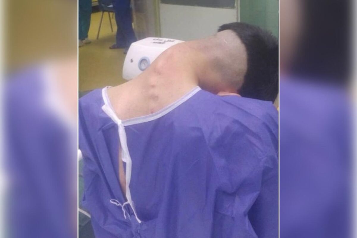 Caso raro: homem tem síndrome da “cabeça caída” causada por vício