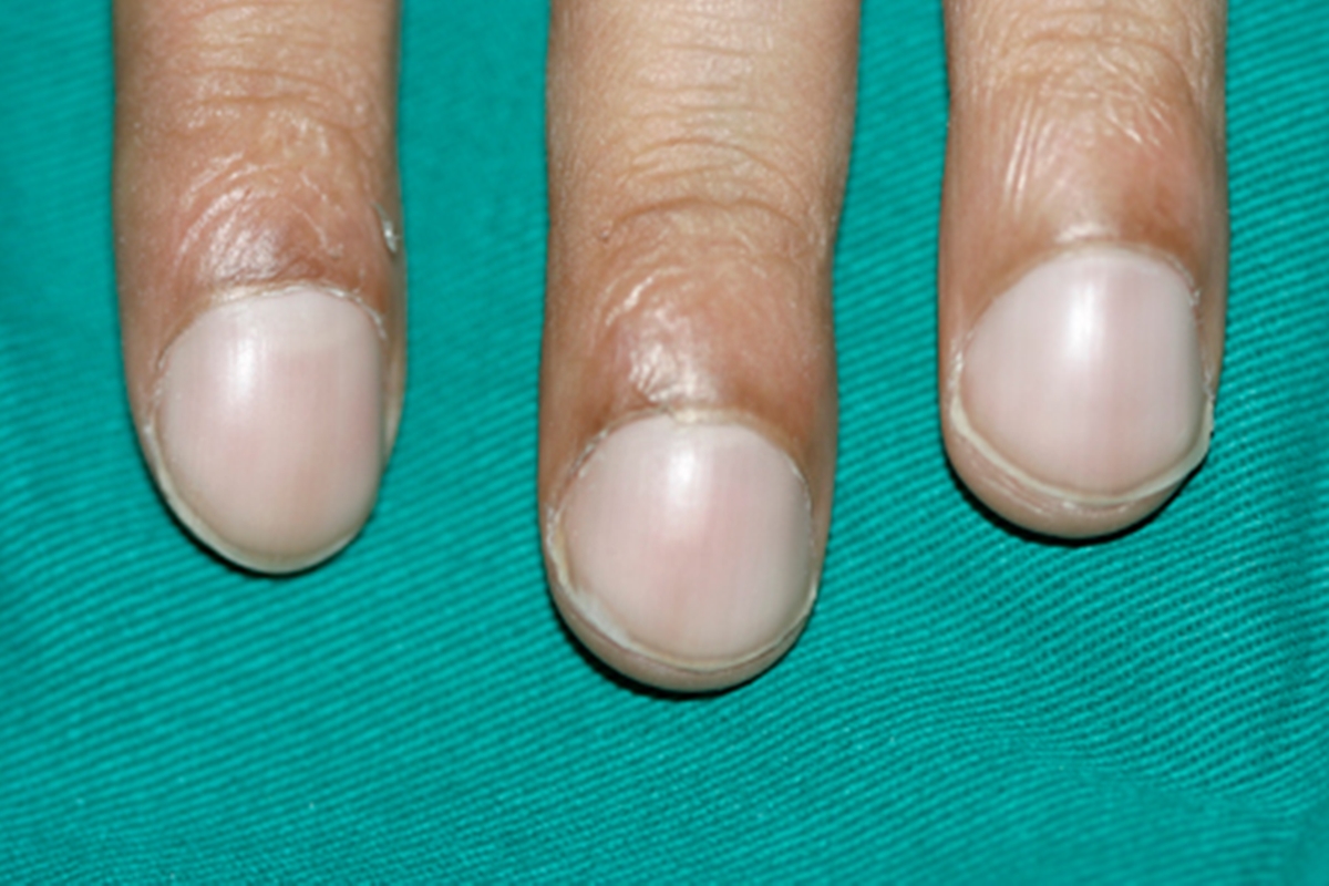 Imagem mostra dedos com unhas inchadas em fundo verde - Metrópoles