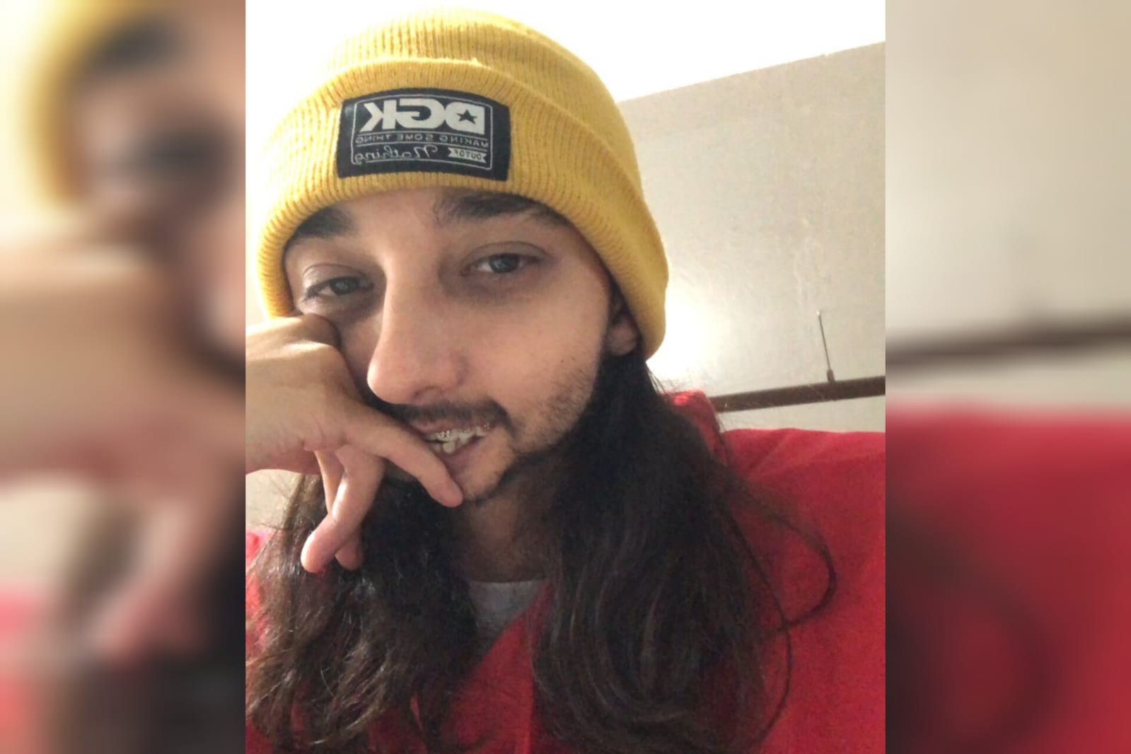 Jovem que perdeu mandíbula por câncer fará cirurgia de reconstrução