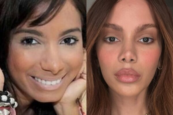 Médica detalha procedimentos realizados por Anitta e fala de excessos - Metrópoles