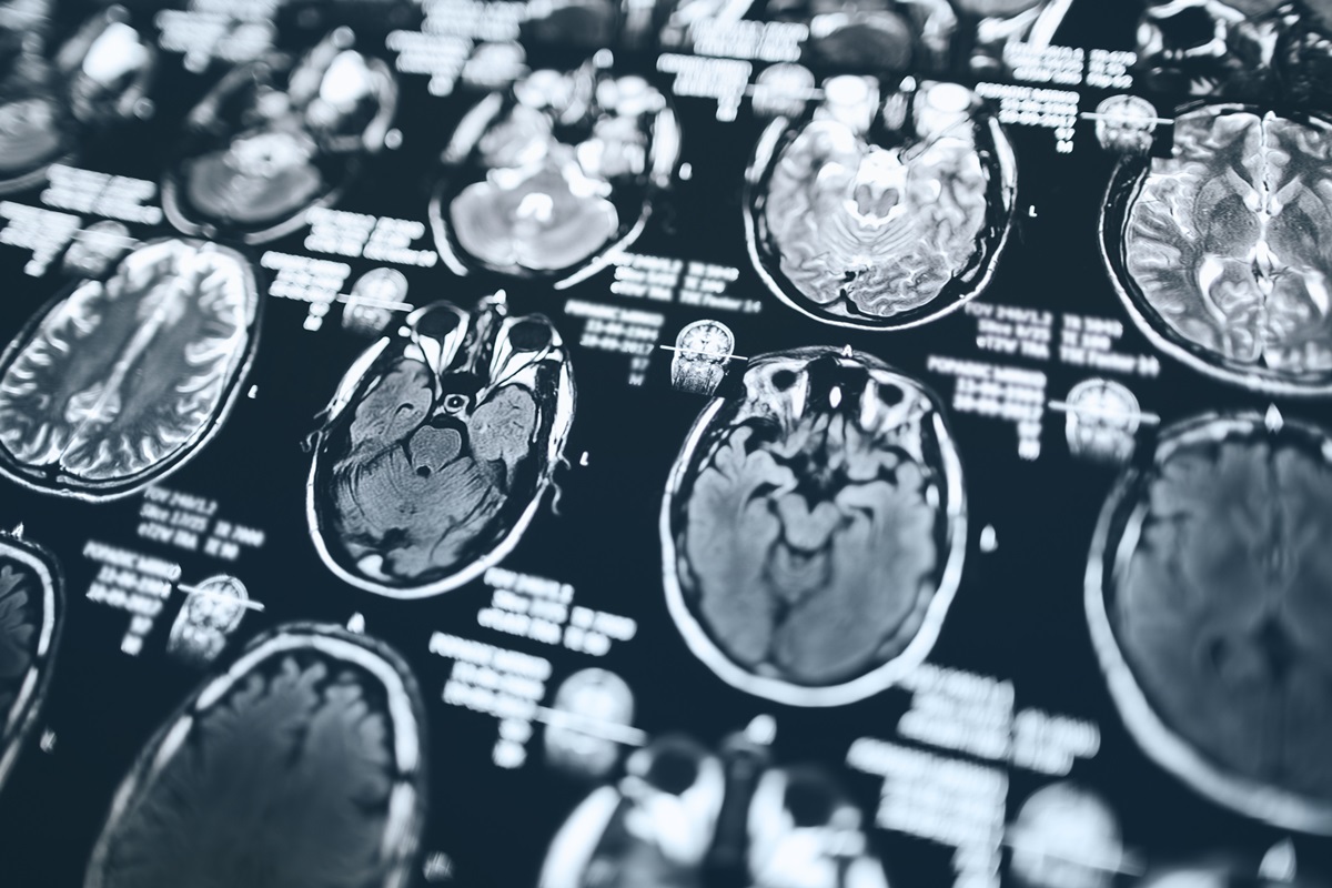 Ressonância cerebral pode prever ritmo de envelhecimento do corpo
