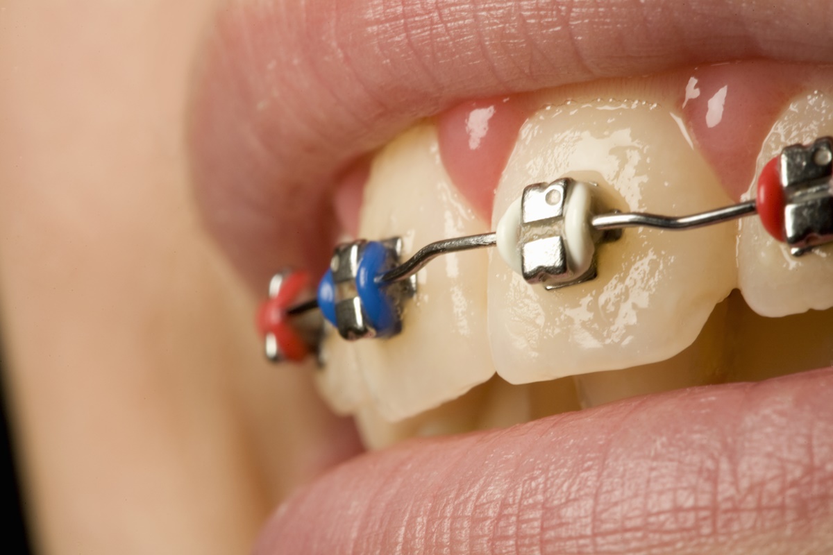 Imagem colorida de pessoa com aparelho dental - Metrópoles 