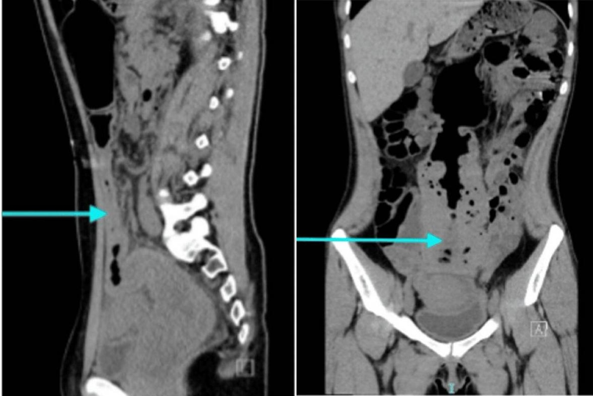Com histórico de constipação desde a infância, jovem de 25 anos precisou de internação e sessões de desimpactação manual. Mulher constipada. Metrópoles.