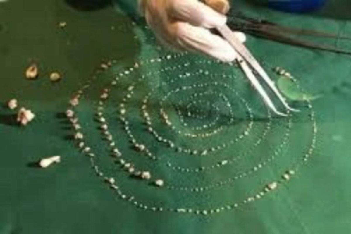 526 estruturas que lembravam dentes foram encontradas no garoto. Metrópoles